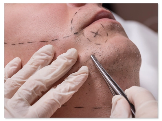 hair-transplantation-beard-treatment-Banjara Hills-Hyderabad 