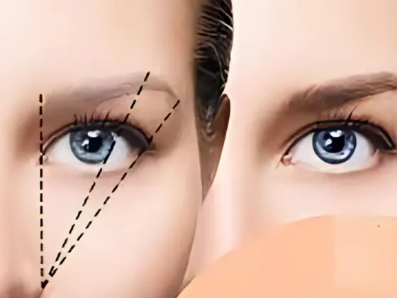 hair-transplantation-eyebrows-Banjara Hills-Hyderabad