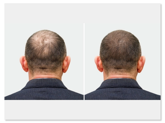 hair-transplantation-head-Banjara Hills-Hyderabad