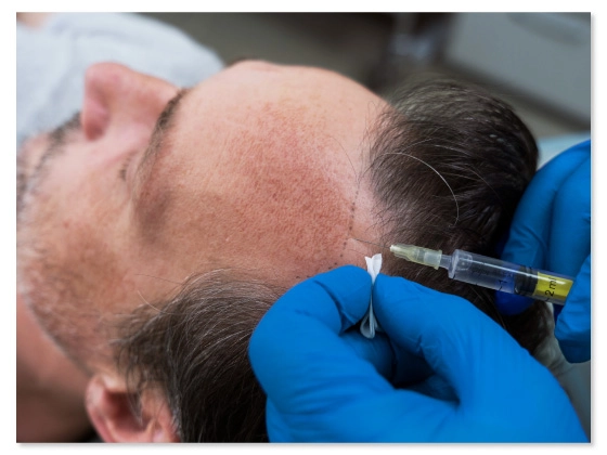 scalp-micropigmentation-Banjara Hills-Hyderabad